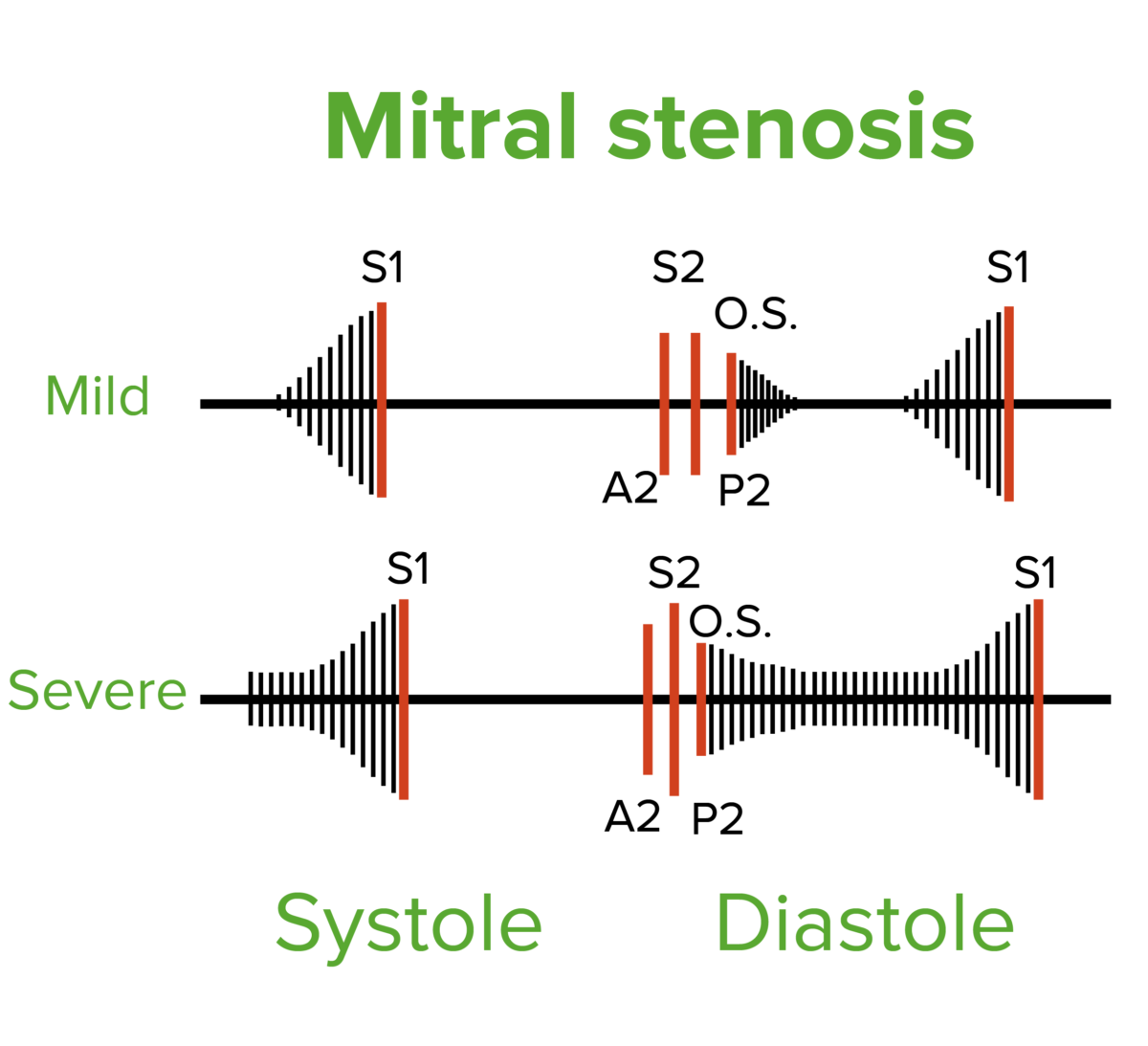 Diastolic filling and rumbling murmur of mild and severe mitral stenosis