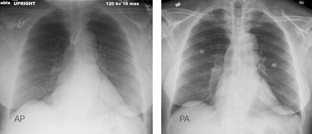 Differences between ap (left) and pa (right) x-ray projections