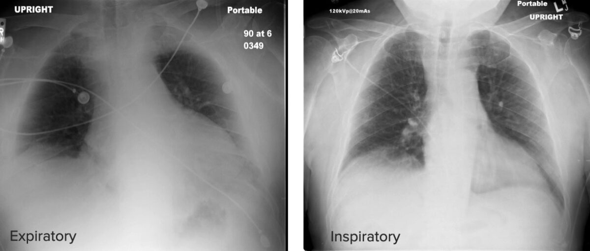 Differences between expiratory and inspiratory chest x-ray