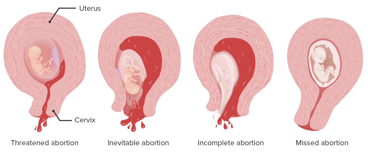 Første menstruation efter spontan abort.