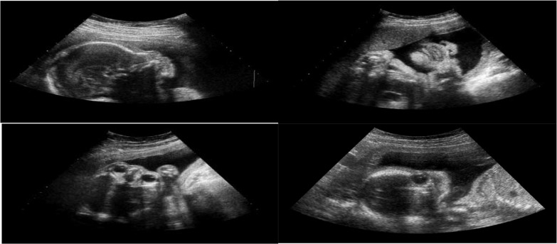 Different planes of fetal ultrasound (sonography)