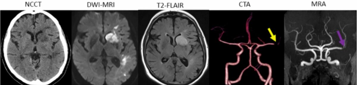 Different brain imaging modalities for stroke