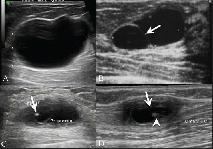 Different breast ultrasounds