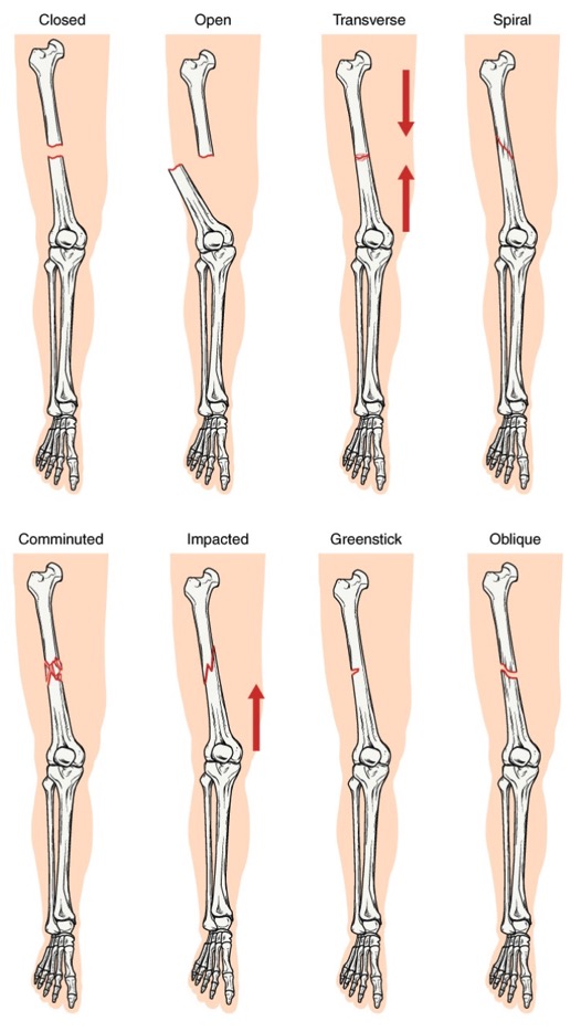 Diferentes tipos de fracturas