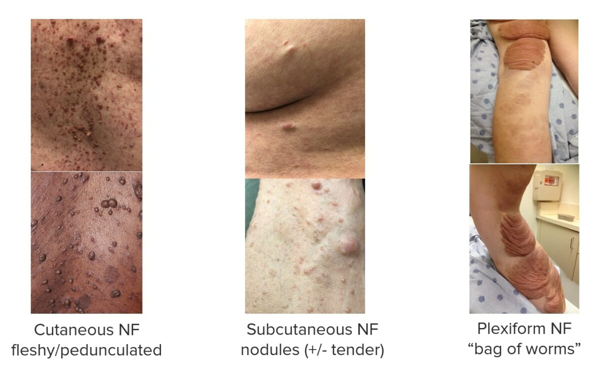 Different types of neurofibromas associated with nf1