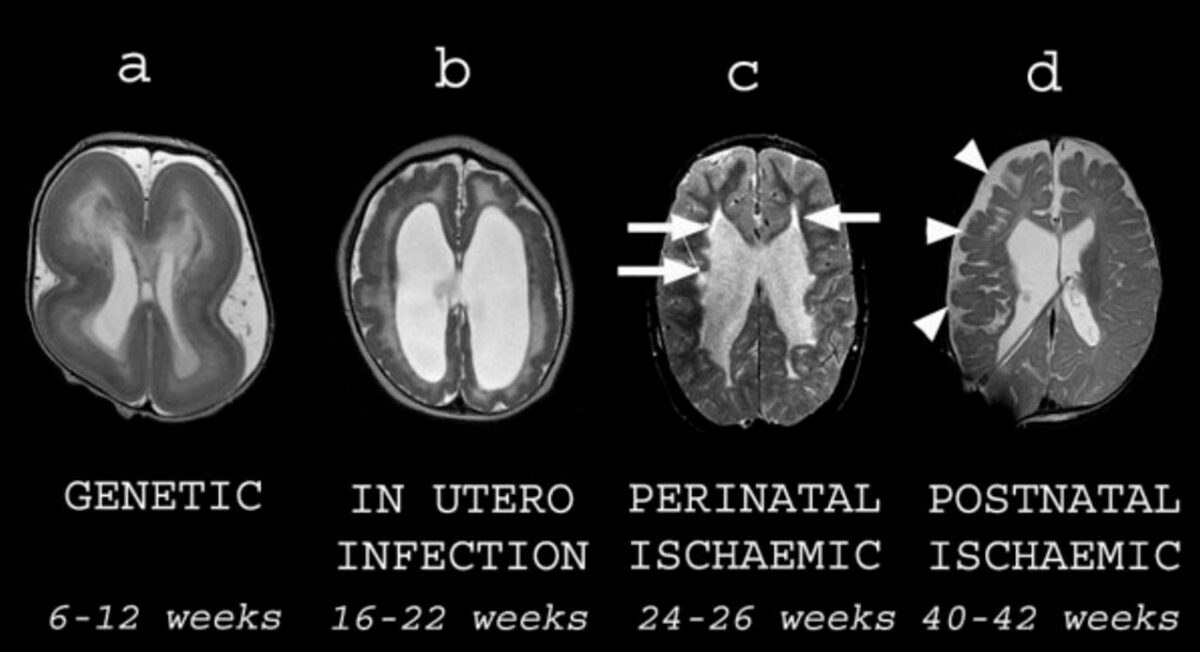 Diferentes tipos de anormalidades cerebrais estruturais na paralisia cerebral