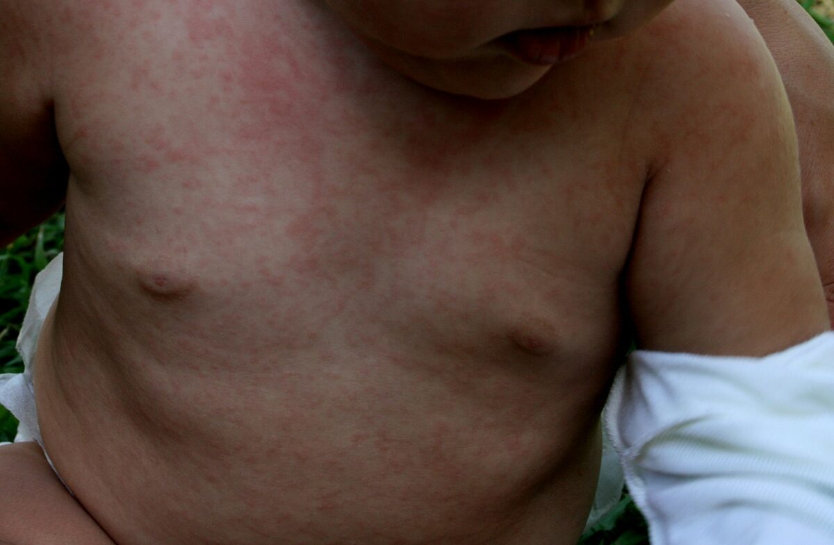 Diffuse maculopapular rash on the chest and abdomen due to roseola infantum