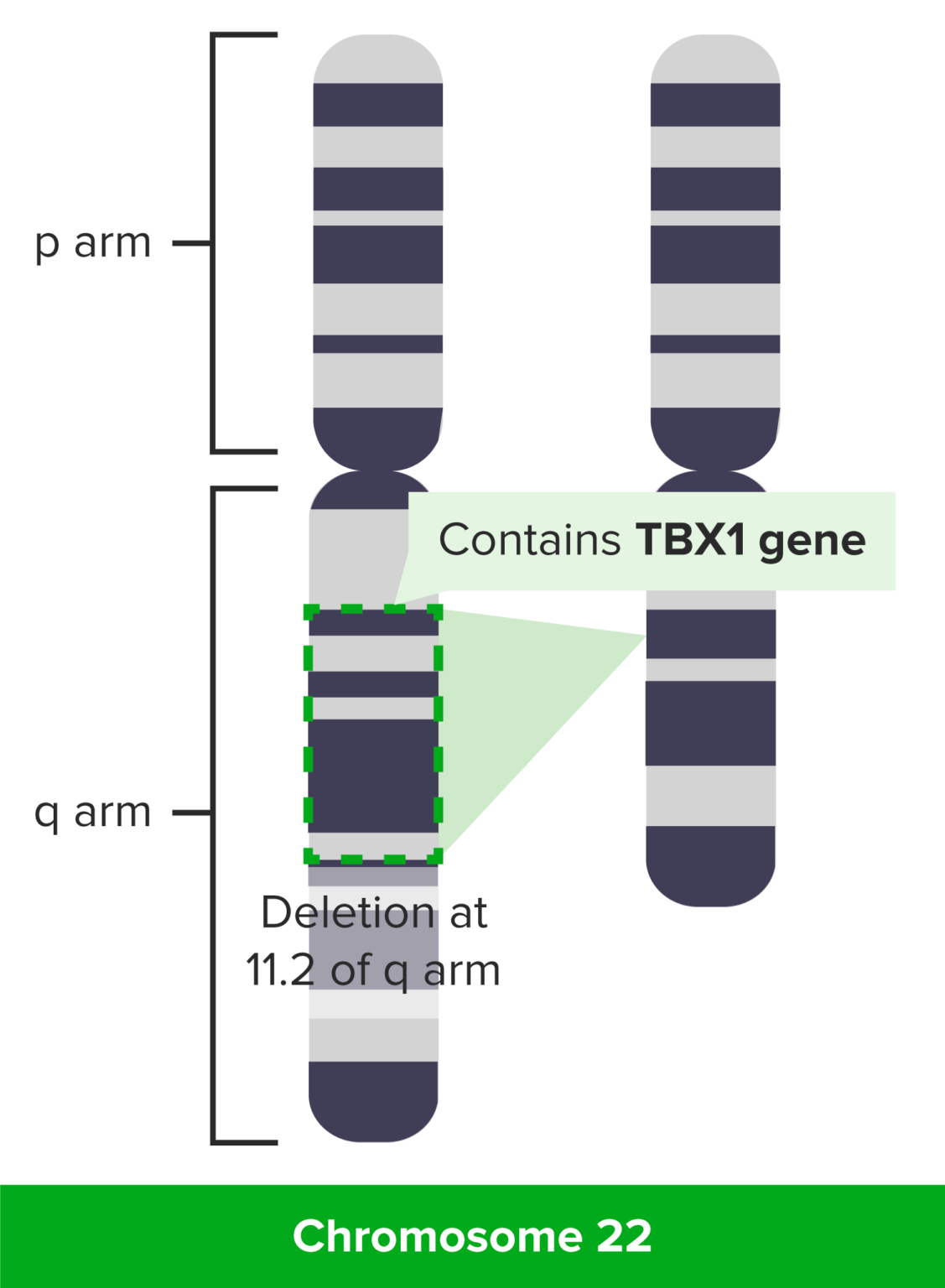 DiGeorge Syndrome | Concise Medical Knowledge