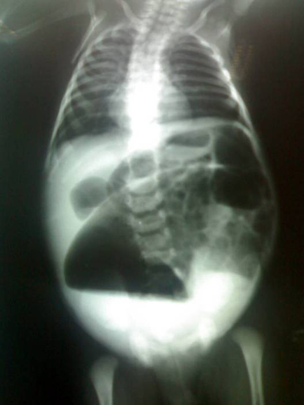 Dilated bowel loops on an abdominal radiograph
