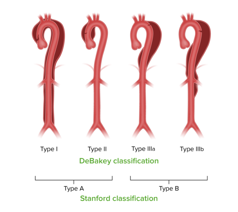 Aortic Dissection | Concise Medical Knowledge