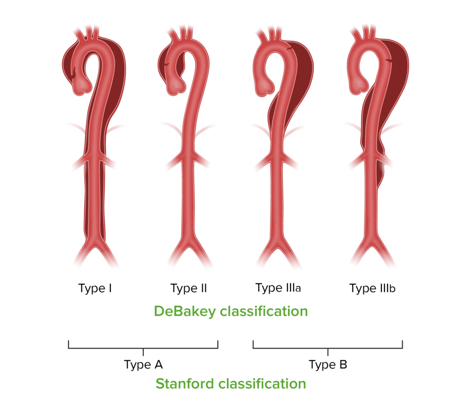Stanford and debakey classifications for aortic dissection