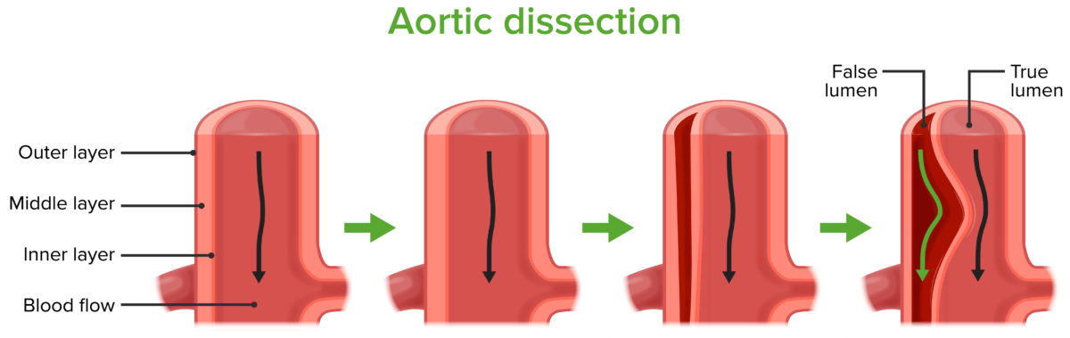 Dissection of the carotid and vertebral arteries