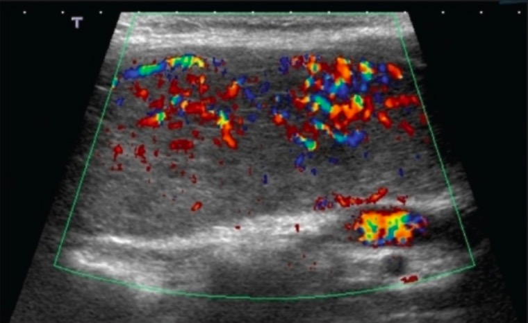 Doppler ultrasound of thyroid graves disease