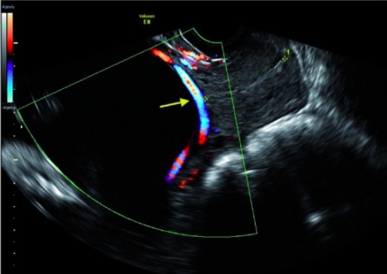 Doppler ultrasound of vasa previa