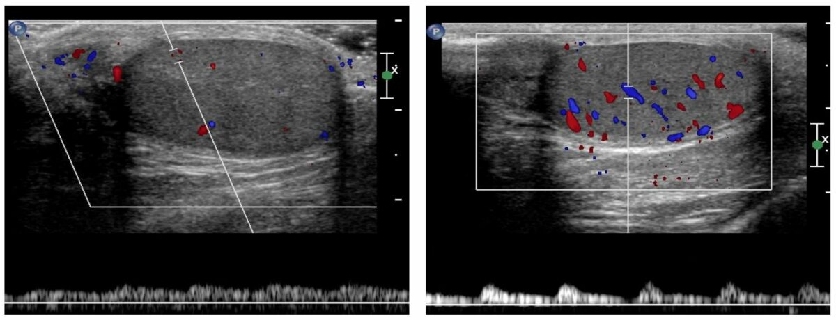 Doppler ultrasound showing normal arterial and venous flow
