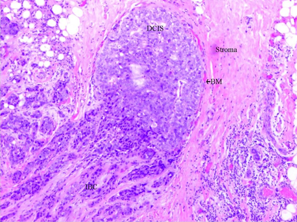 invasive ductal carcinoma histology