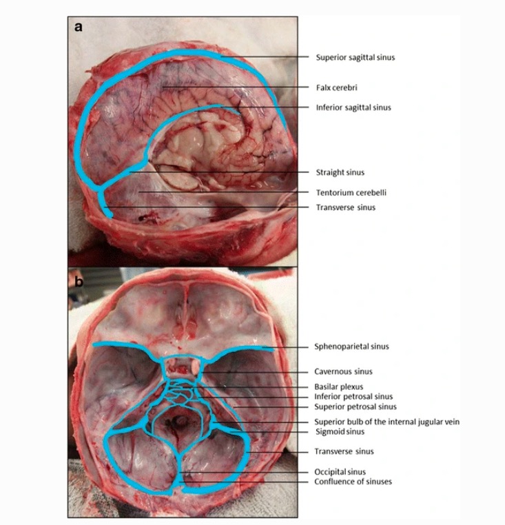 tentorium cerebelli cadaver