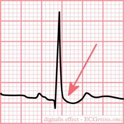 Ecg typical “scooped” st-depression resulting from digoxin use