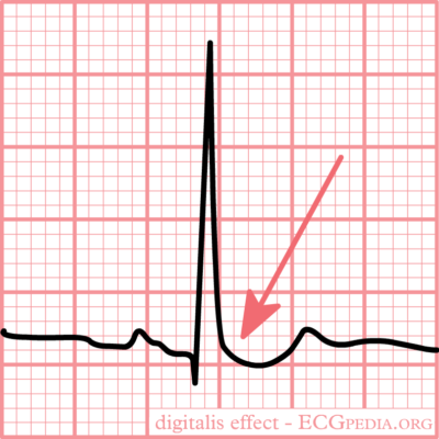 Ecg depressão de st “escavada” típica resultante do uso de digoxina