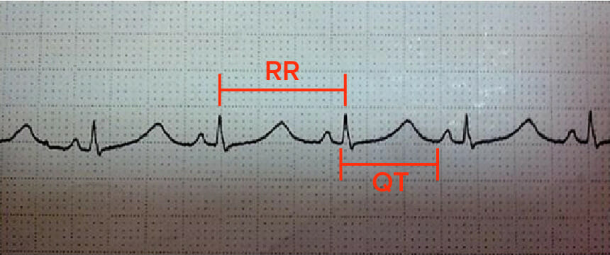 Ecg in a patient with long qt syndrome