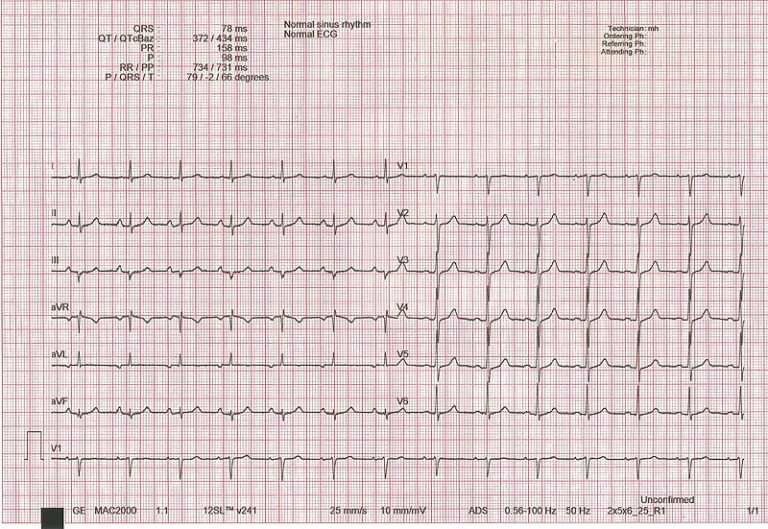 How to Read an ECG: Interpretation & Components | Lecturio Medical