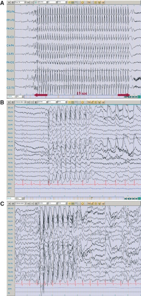 eeg findings absence seizures