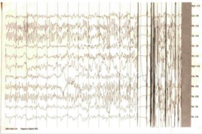 Eeg showing interictal spikes and polyspikes - tonic clonic seizure