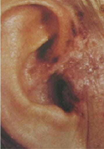 Vesículas da orelha observadas na síndrome de ramsay-hunt.