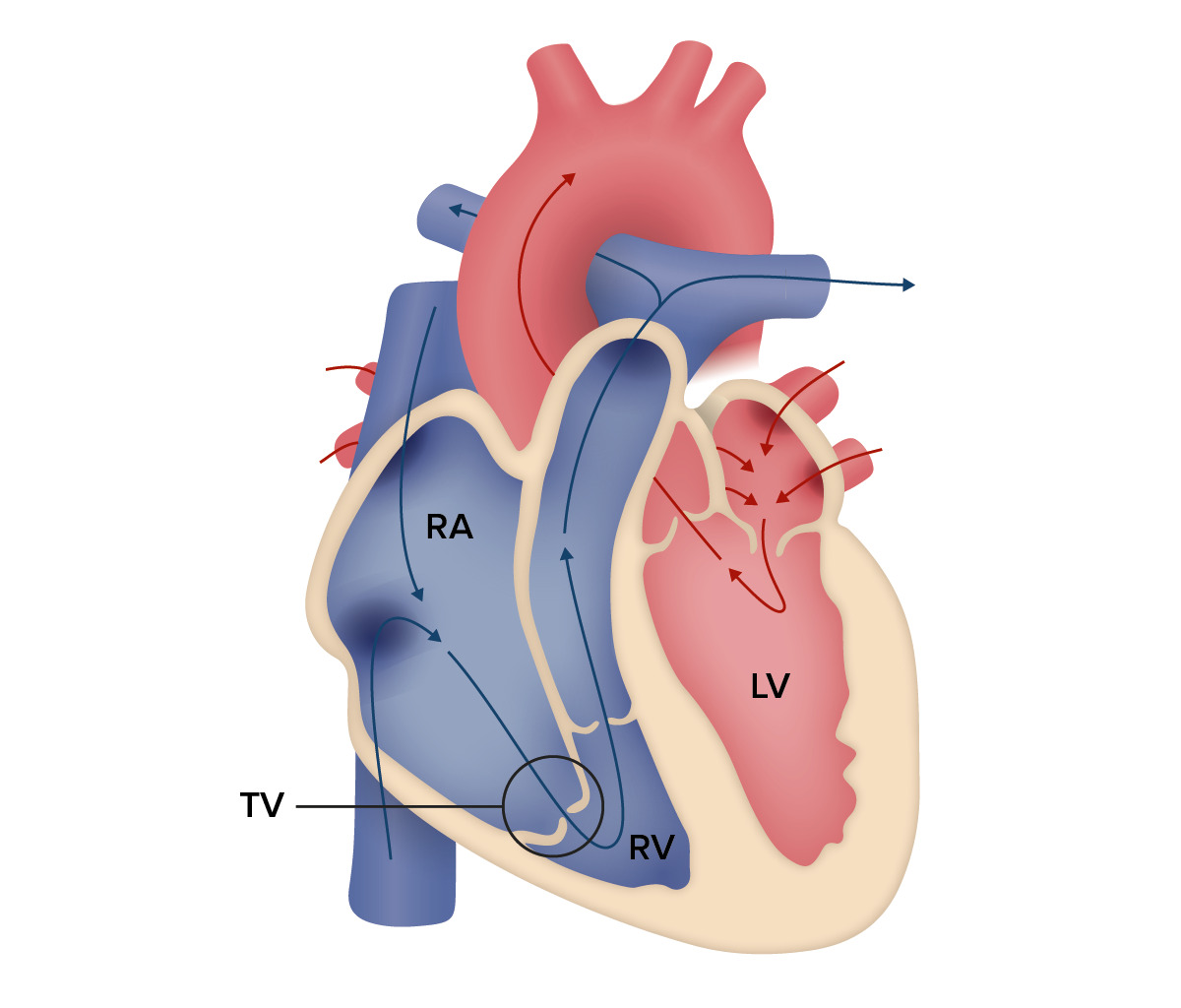 Ebstein's Anomaly | Concise Medical Knowledge