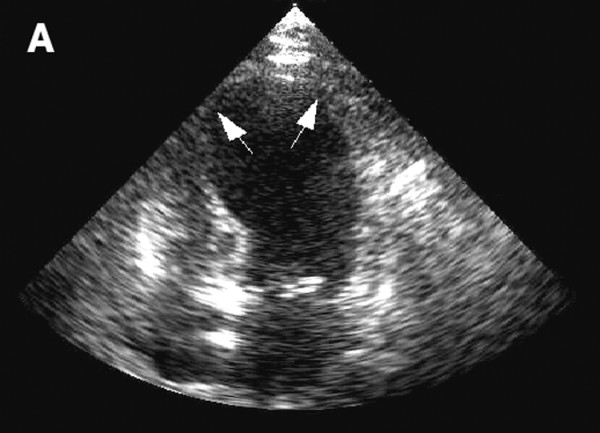 Echocardiogram showing left ventricular dilatation during acute heart failure