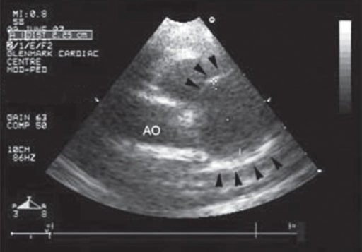 Echocardiography kawasaki