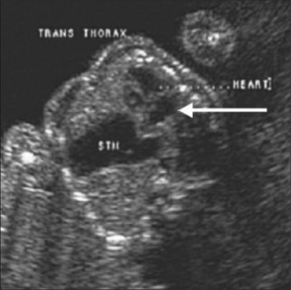 Echocardiography congenital diaphragmatic hernia