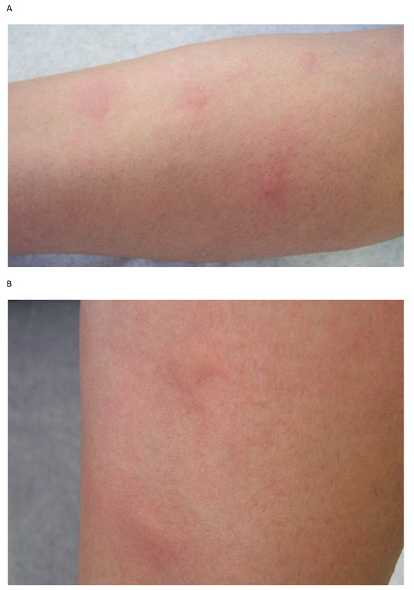Edematous wheals suggestive of urticaria. This can be a manifestation of a drug eruption.