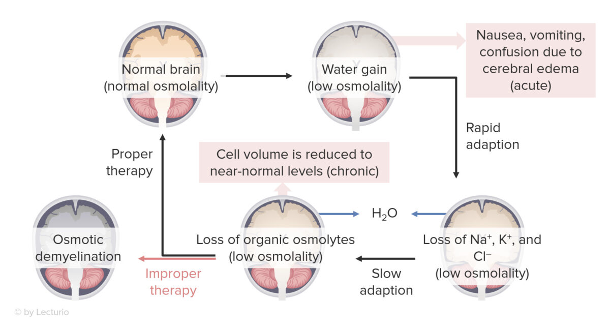 Effects of hyponatremia on the brain