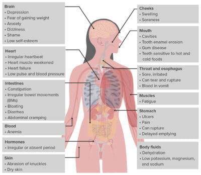 Effects of bulimia on different systems in the body