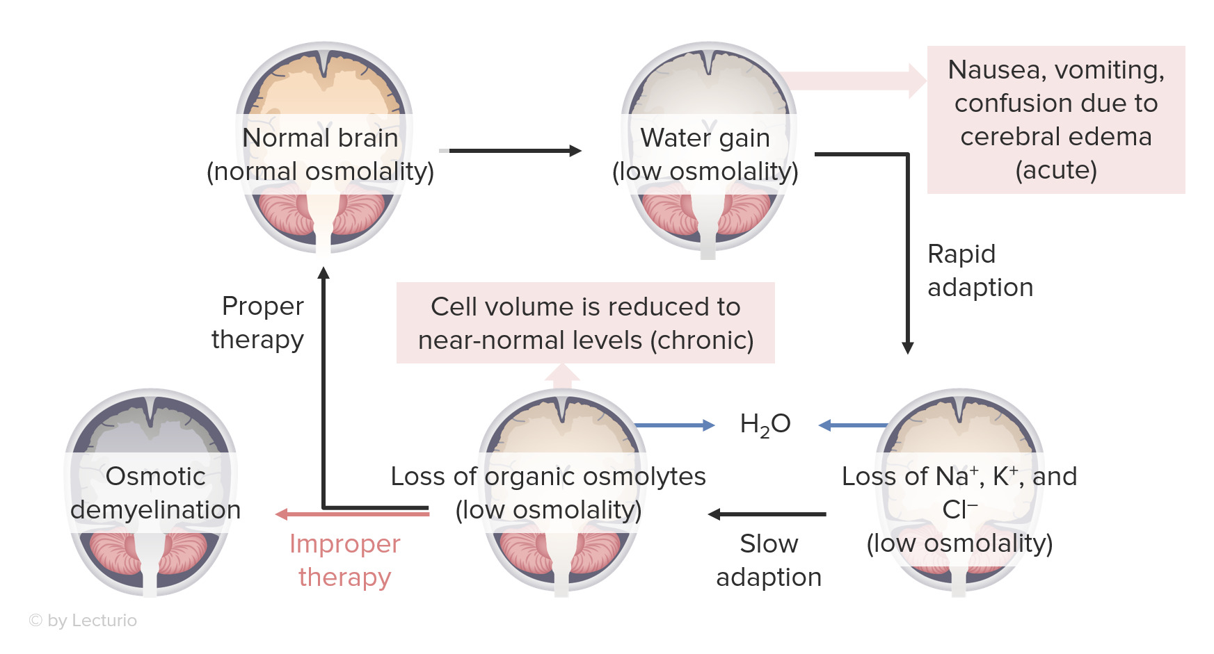 Hyponatremia Concise Medical Knowledge