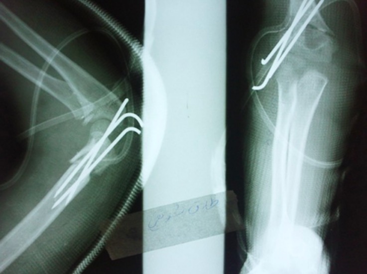 Elbow radiography of supra fracture