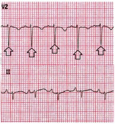 Derrame Pericárdico Y Taponamiento Cardíaco | Concise Medical Knowledge