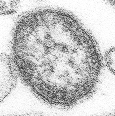 Electron micrograph of measles