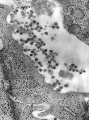 Electron micrograph of rubella virus