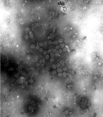 Electron micrograph showing bk virus jc virus and bk virus