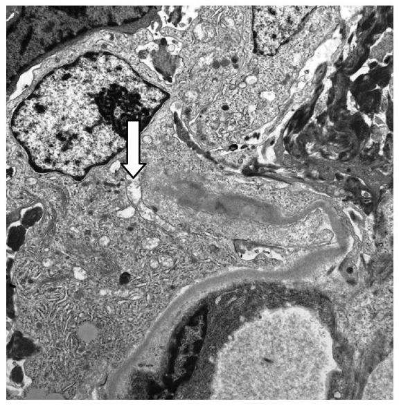 Electron micrograph showing broken glomerular capillary wall in goodpasture disease