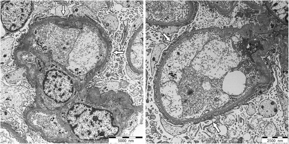 Microscopía electrónica de un glomérulo visto en un paciente con enfermedad de cambios mínimos