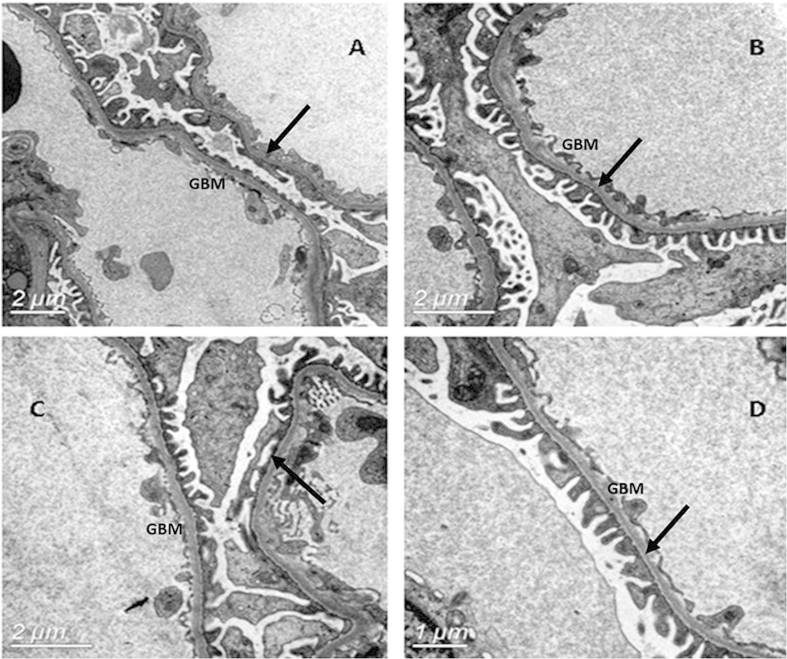 Electron microscopy of the glomerular basement membrane thin basement membrane disease