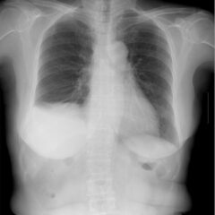 Elevation of the right hemidiaphragm associated with basal atelectasis