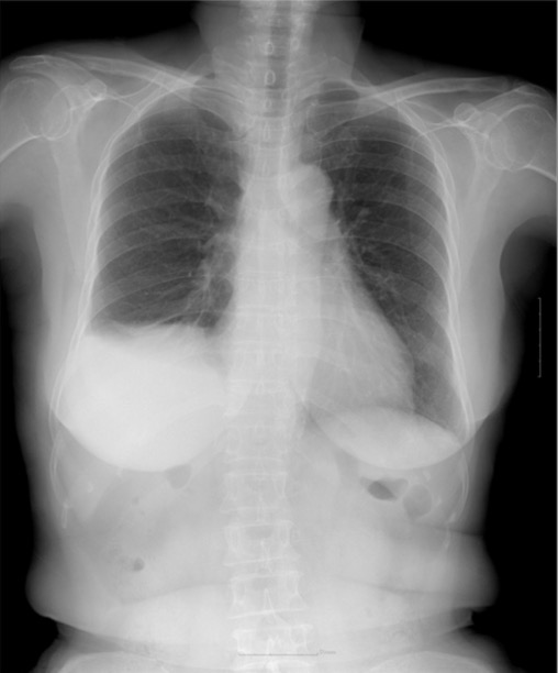 Elevation of the right hemidiaphragm associated with basal atelectasis