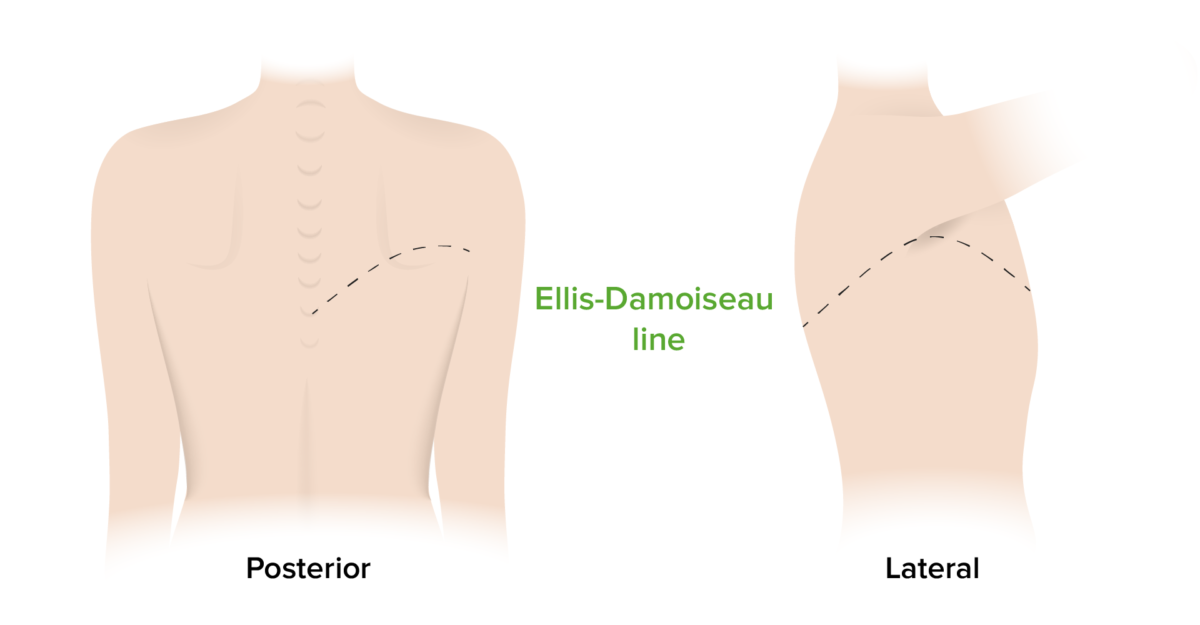 Línea ellis-damoiseau