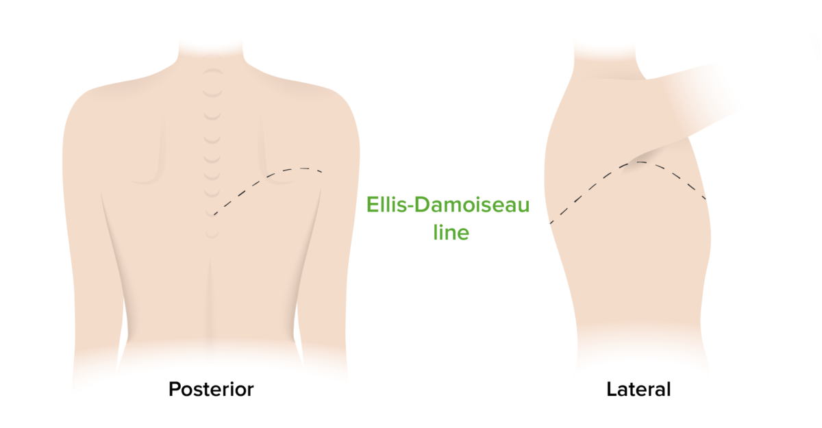 Ellis–damoiseau line