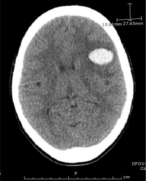 Emergent head ct demonstrating the larger of two frontoparietal hemorrhages