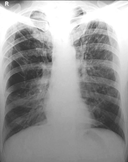 Emphysema on x-ray